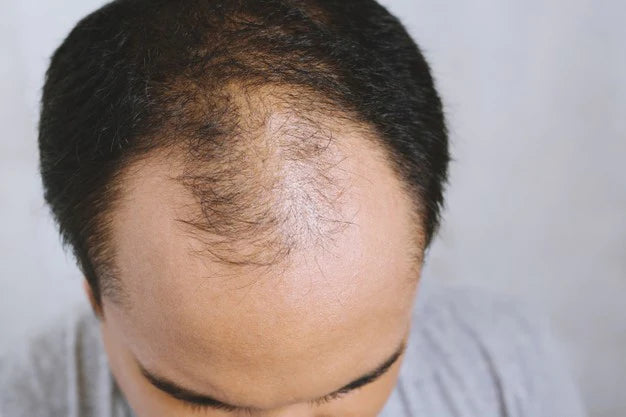 l carnitine male pattern baldness Dr Shishir Gupta | Think L-Carnitine is making you lose hair? Think again. There's no scientific evidence linking L-Carnitine to hair loss, in fact, some Male Pattern Baldness: Causes, Stages,