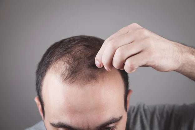 Man showing bald scalp | best hair fall treatment