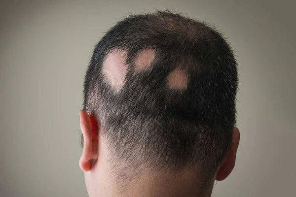 Man showing baldness | best hair regrowth oil for baldness