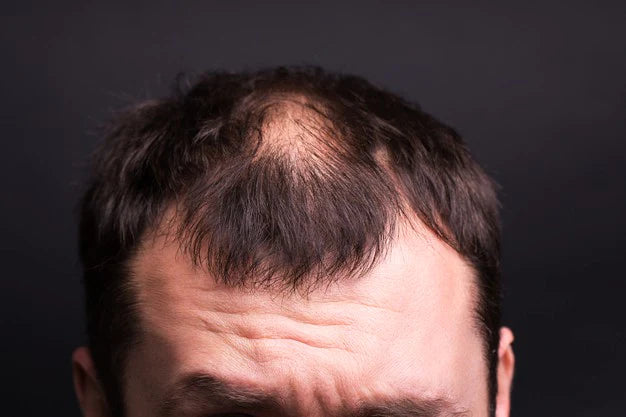 male baldness close up | thinning hair at templates