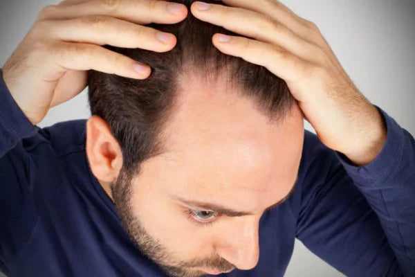 Man showing balding | hair loss shampoo