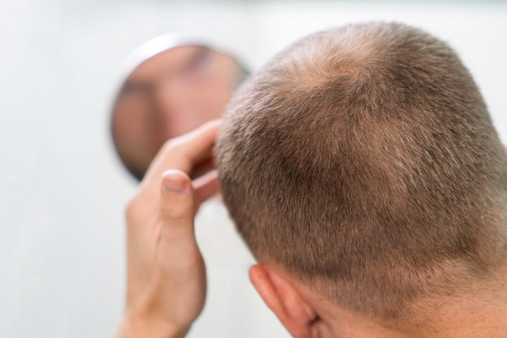 How do a low immune system causes hair loss? | low immunity | man with less hair | man looking in the mirror 