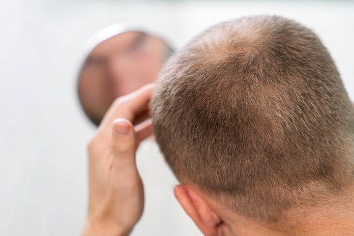 How do a low immune system causes hair loss? mars by GHC How do a low immune system causes hair loss? mars by GHC