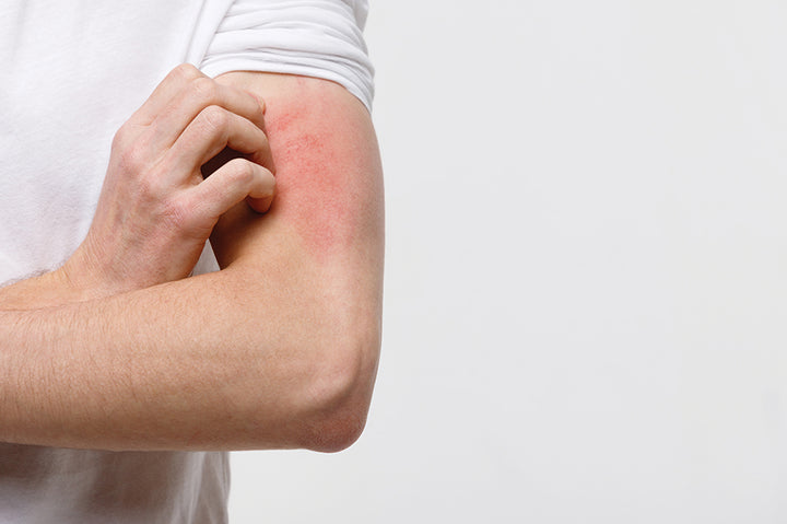 How to Cure Eczema Permanently