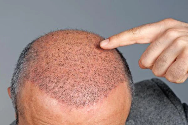 hair transplant | Is Hair Transplant helpful for all kinds of Hair Loss?