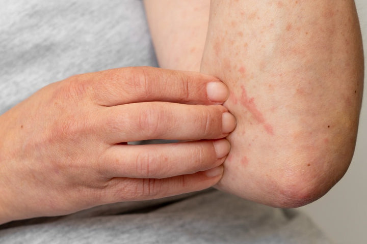 Skin rash: Causes and ways to Prevent It mars by GHC Skin rash: Causes and ways to Prevent It mars by GHC
