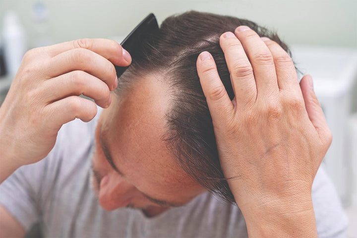 Man with baldness combing hair | Trouble With Hair Loss? Things To Avoid When You Have Alopecia Areata