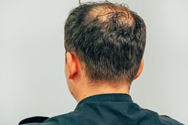 Is there any real solution to male baldness?