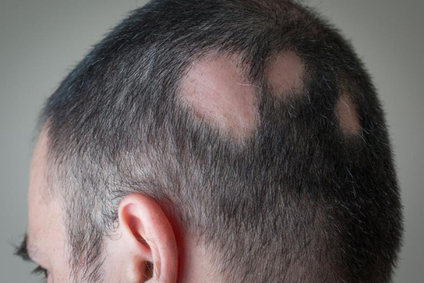 Hair loss in patches
