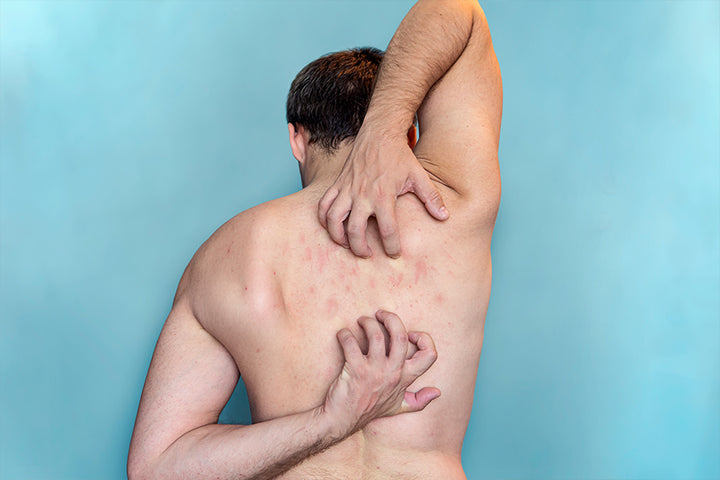 Unveiling the Culprits What Causes Back Acne in Males
