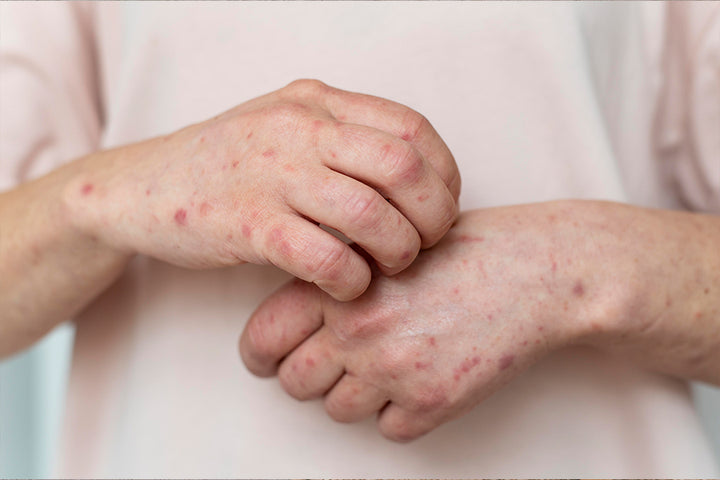 Hands with itchy skin | what causes itchy skin