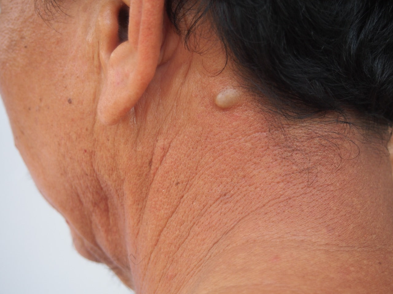 What are the treatments for sebaceous cyst? – mars by GHC