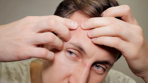 What causes forehead acne?