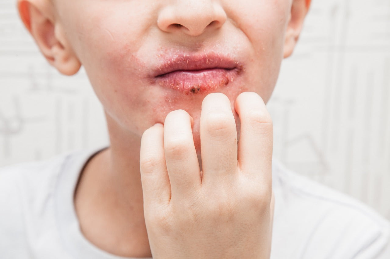 Lips Rushes 7 Tips to prevent rashes on lips – mars by GHC
