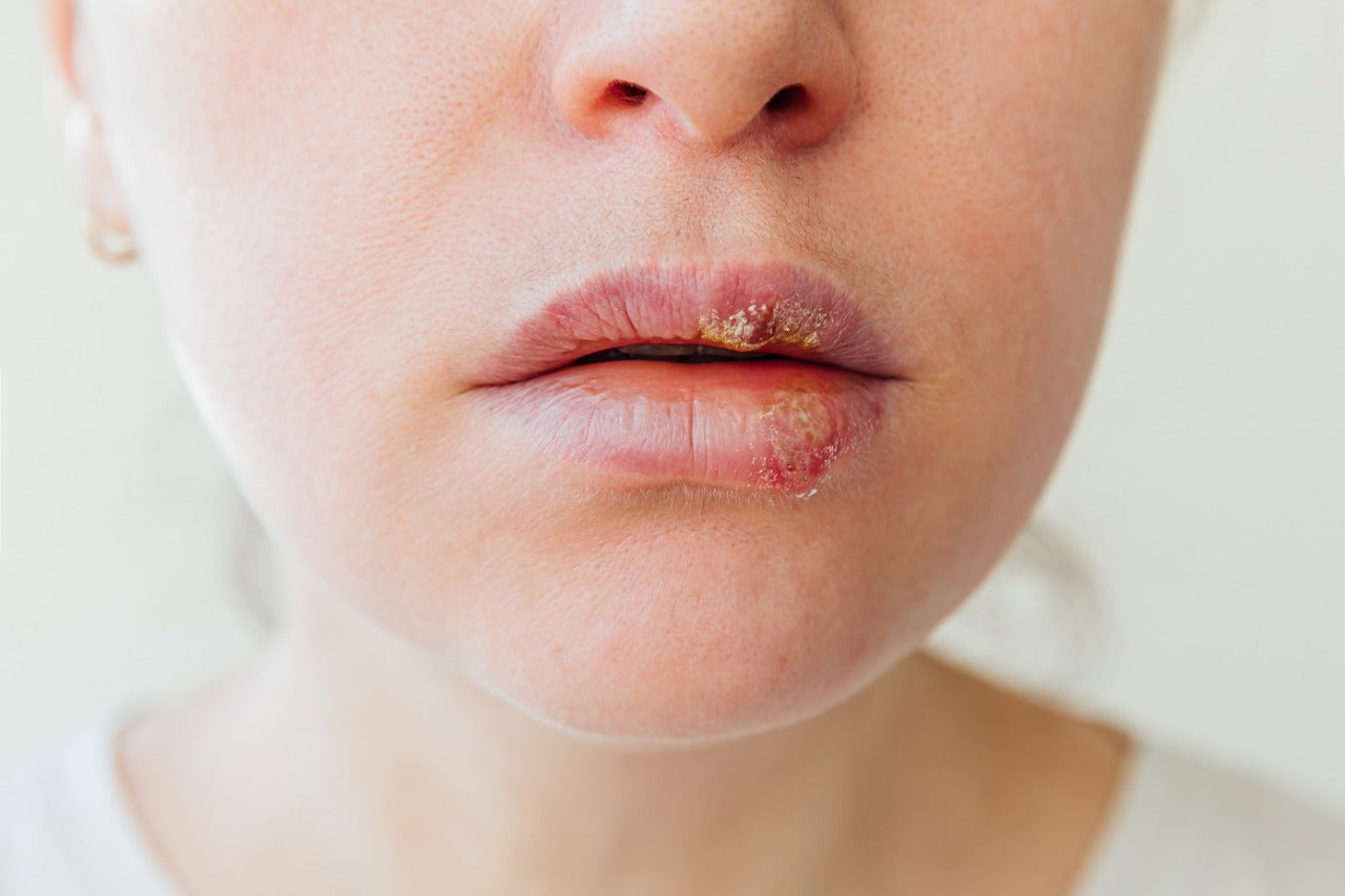 Home remedies for swollen lips – mars by GHC