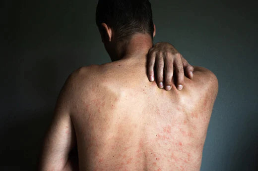Treatment for back acne