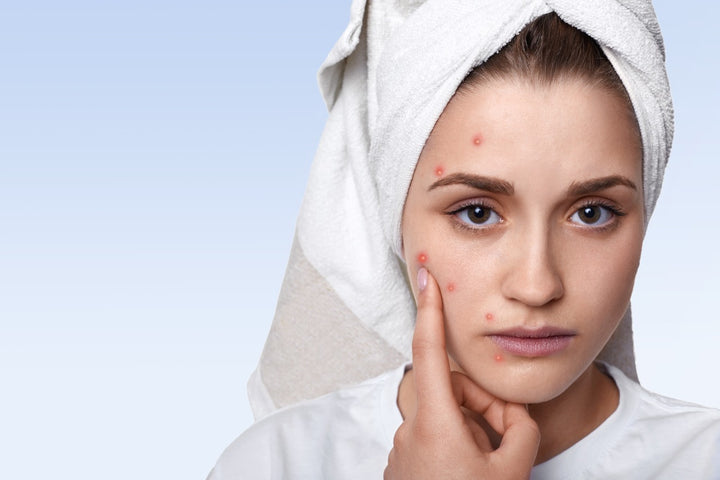 Salicylic acid is a beta-hydroxy corrosive, which is an exfoliant and eliminates dead skin. 