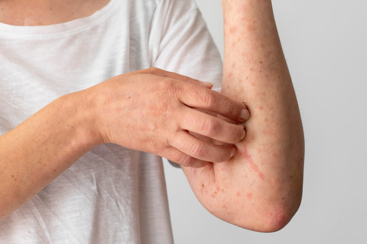 A winter rash can affect everyone, but some people are more susceptible than others.