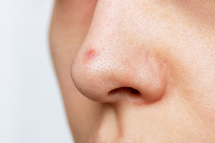  Enlarged Nose Pores
