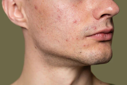 Do eggs cause acne in summer?