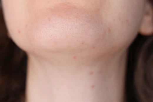 Treatment for neck acne