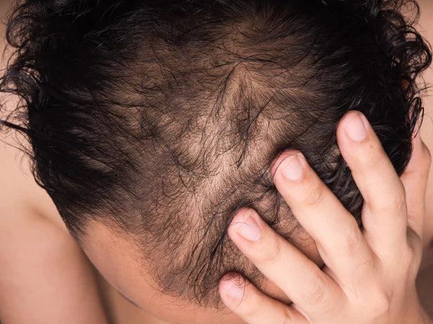 Why is my hair thinning and shedding? I am only 17 | bald man | hair loss