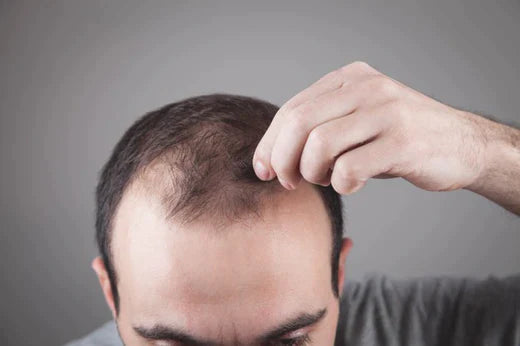 Common Causes Of Hair Fall 