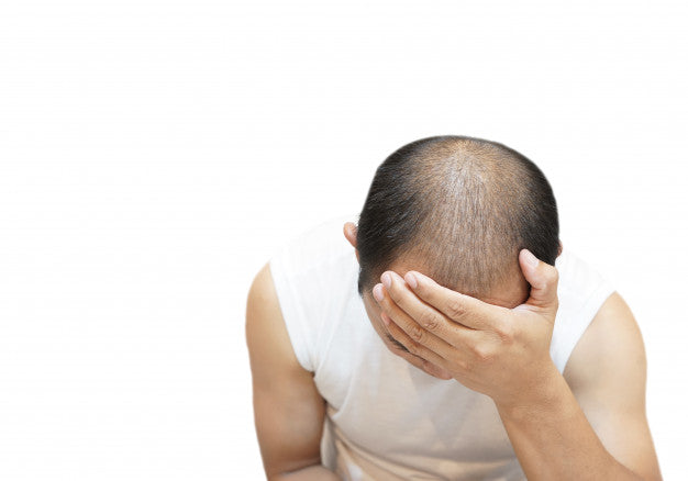 Male pattern baldness 